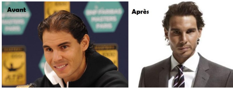 Le joueur du tennis Nadal après sa greffe de cheveux