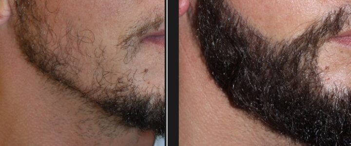 Barbe, cheveux et moustache : Techniques de greffe innovantes greffe-barbe-tunisie
