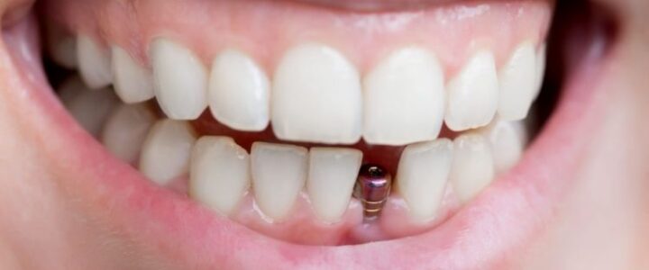 Implants dentaires : la solution la mieux adaptée pour remplacer des dents perdues
