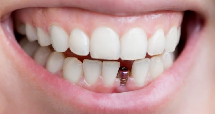 Dental implants Tunisia