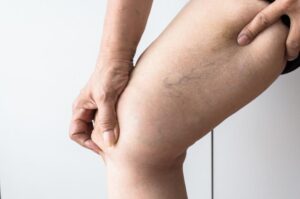 Varicose veins treatment