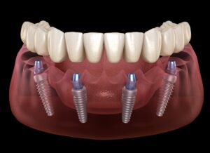 implant dentaire Quebec