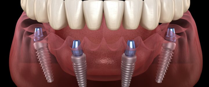 dental implant Quebec