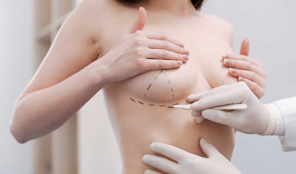 aumento mamario con prótesis  