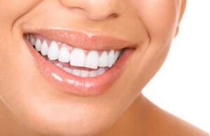 Teeth whitening in Tunisia