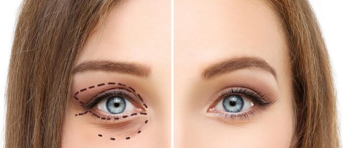 Combien coûte une chirurgie esthétique des paupières à Montréal : Guide des prix et détails