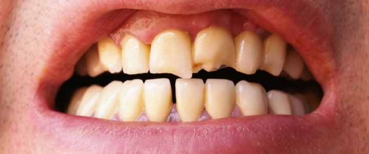 Traitement des dents fissurées : techniques et soins Traitement des dents fissurées : techniques et soins