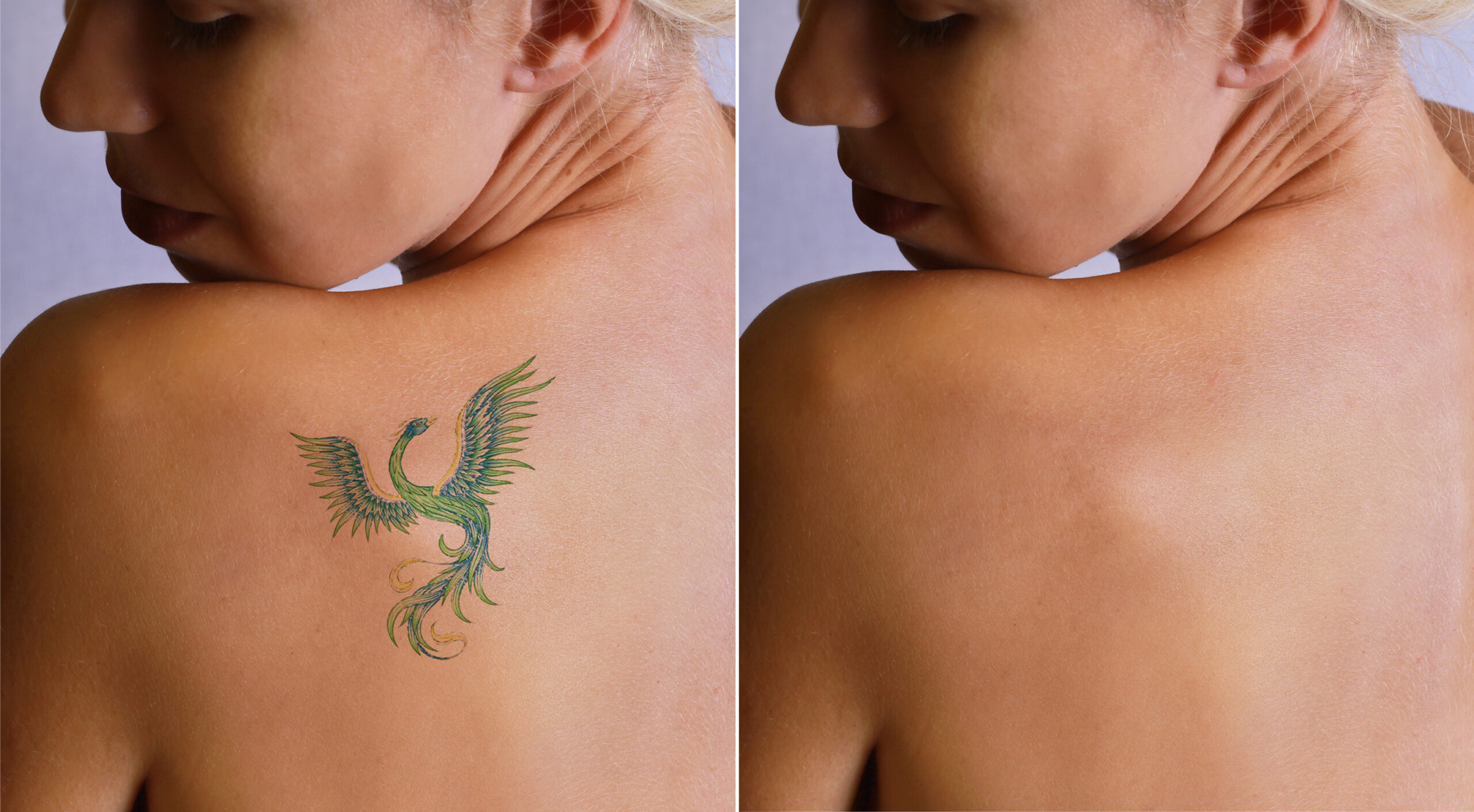 eliminación de tatuajes con láser túnez