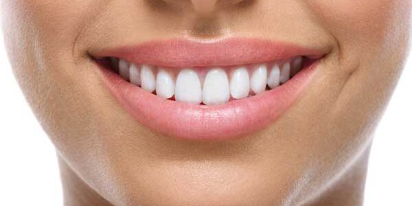 dental veneers montreal