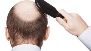 Hair Transplant Tunisia