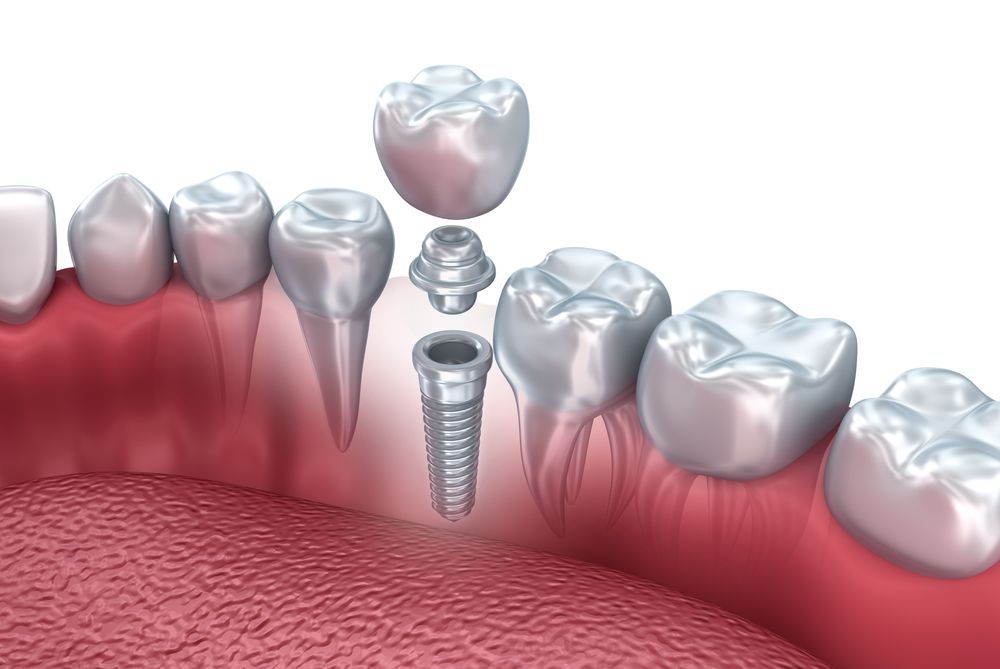 Cuáles son los efectos secundarios de los implantes dentales