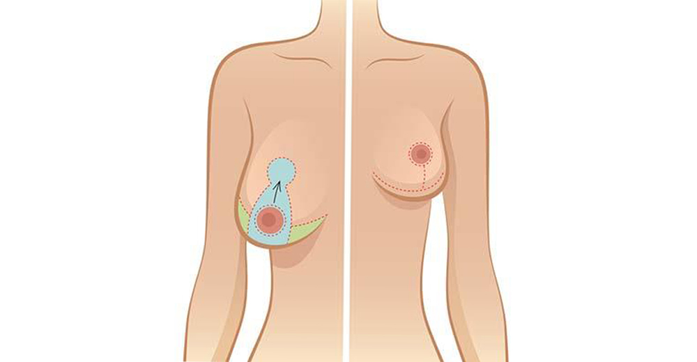 chirurgie ptose mammaire Tunisie