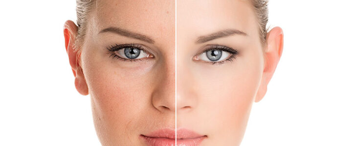 Quelles sont les complications d’un lifting du visage ? Risques et précautions