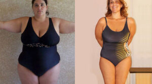 Gastric sleeve tunisia