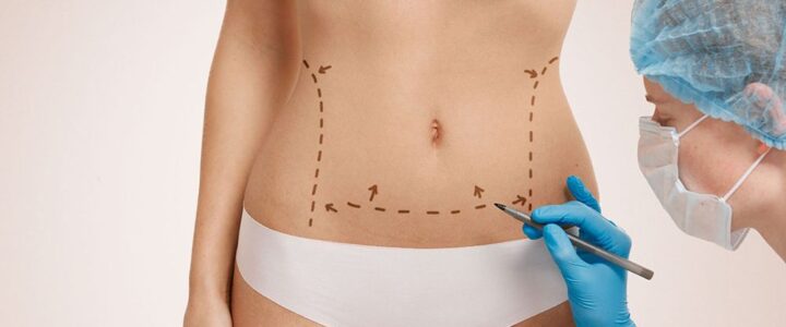 Comment est la cicatrice d’une abdominoplastie ?