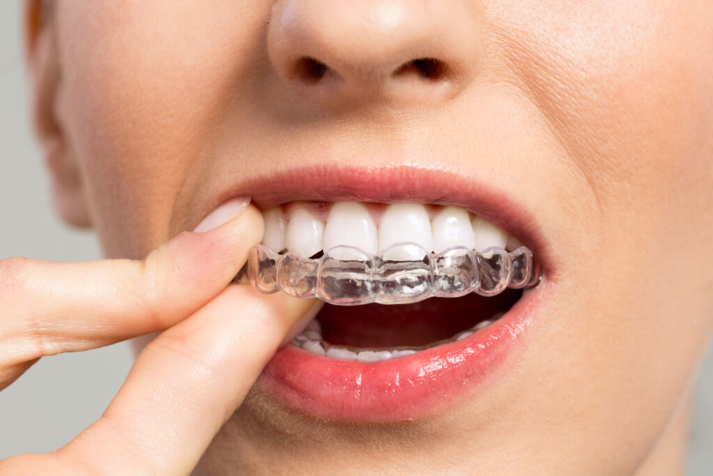 invisalign traitement