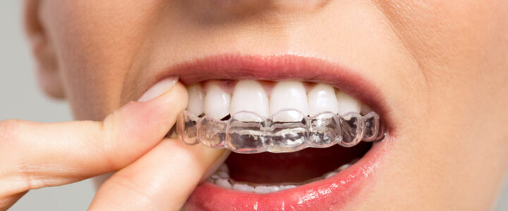 Invisalign Invisalign