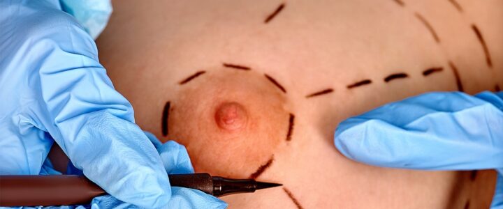 Réduction du mamelon, que faut-il savoir ? Réduction du mamelon, que faut-il savoir ?