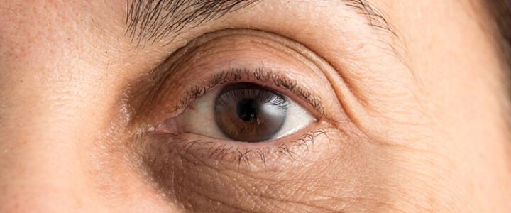 Veines sous les yeux, tout savoir