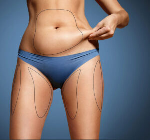 Liposuccion gatineau