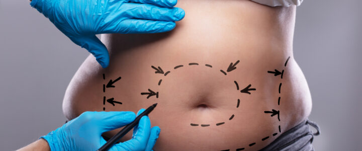 Abdominoplastia Miami : Guía de Expertos y Consejos Prácticos