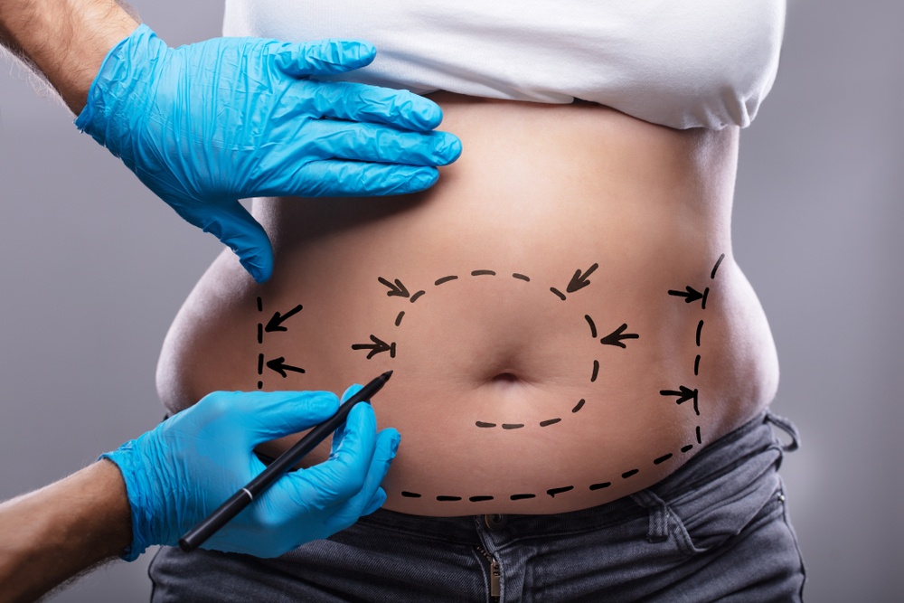 Abdominoplasty in Tunisia