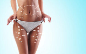 liposuction in Miami