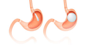 gastric balloon tunisia