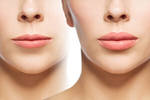 upper lip lift  tunisia