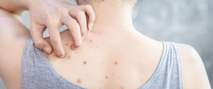 Comment traiter l’acné du dos ?