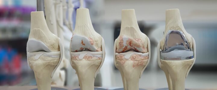 Pain After Knee Replacement : Causes, Duration and Solutions