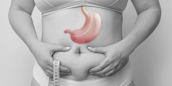 Gastric Sleeve in Quebec