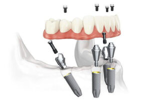 Implant dentaire miami