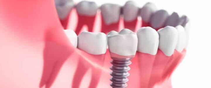 Quel âge pour mettre un implant dentaire ? Conseils et recommandations