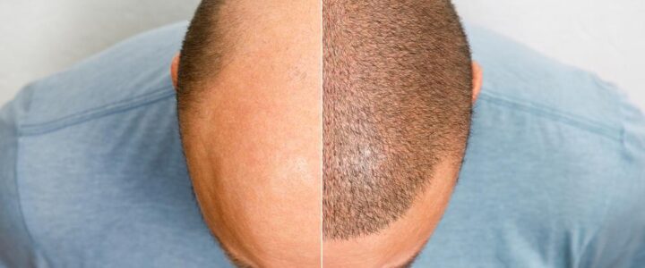 Quel est le prix d’une greffe de cheveux à Ottawa? Tout ce que vous devez savoir