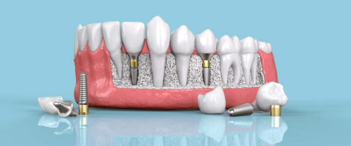 Quels sont les inconvénients d’un implant dentaire ? Risques et effets secondaires