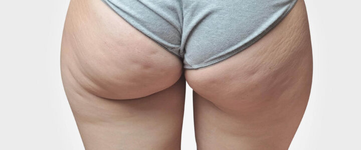 lipo fesses toronto
