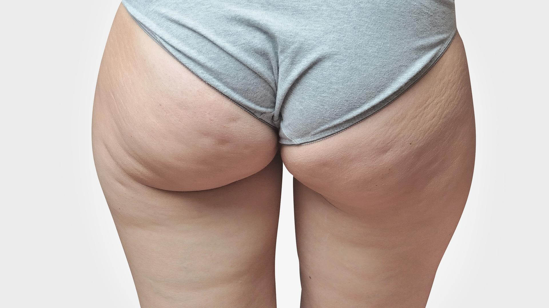 lipo fesses toronto