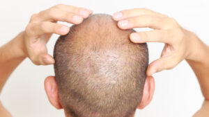 prix greffe cheveux tunisie