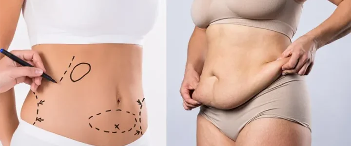 Quel est le prix d’une chirurgie esthétique liposuccion ventre Montreal : ce qu’il faut savoir