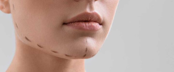 Genioplastia Miami : Beneficios y Procedimiento