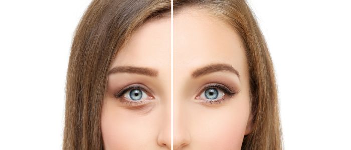 Comment éviter les Bleus après une blépharoplastie ? Conseils pratiques