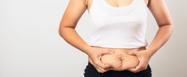 Tarifs chirurgie esthétique ventre fripé