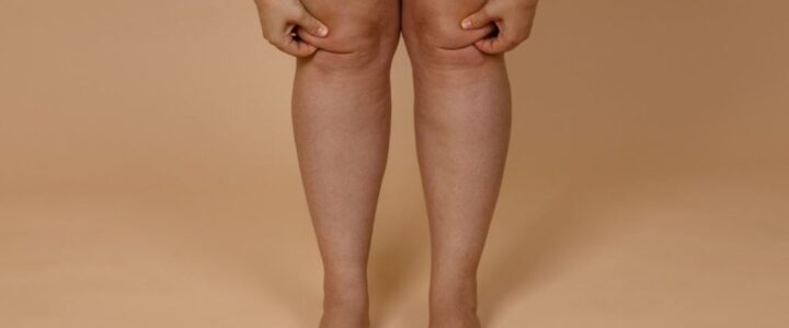 Prix chirurgie genoux fripés : coûts et procédures expliqués