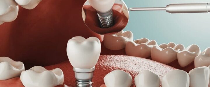 Est-ce que la pose d’un implant dentaire fait mal ? Comprendre la procédure et la douleur liée