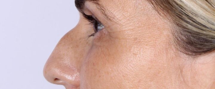 Comment corriger un nez crochu : Guide complet