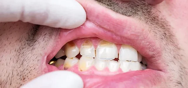 Décalcification des dents : causes et traitements