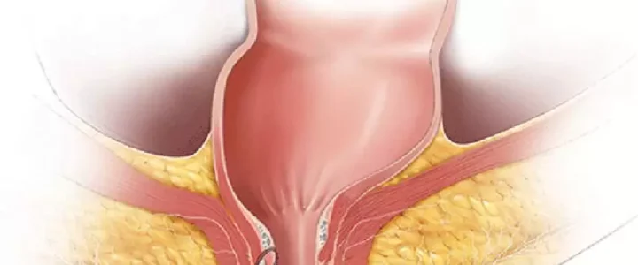 Quelle chirurgie pour traiter une fistule anale ?