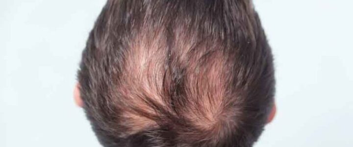 Cheveux fins : ce qu’il faut savoir pour éviter la chute