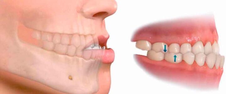 Comment avancer sa mâchoire du bas sans chirurgie ?
